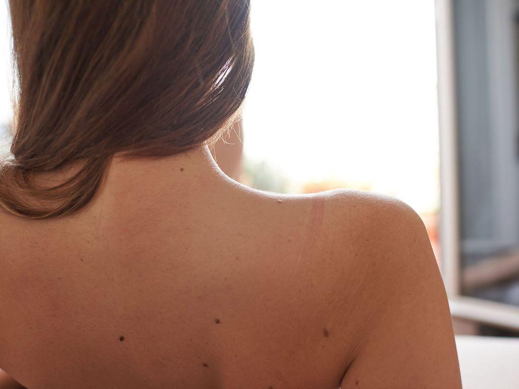 Hautkrebsscreening: Nackter Rücken einer Frau. 