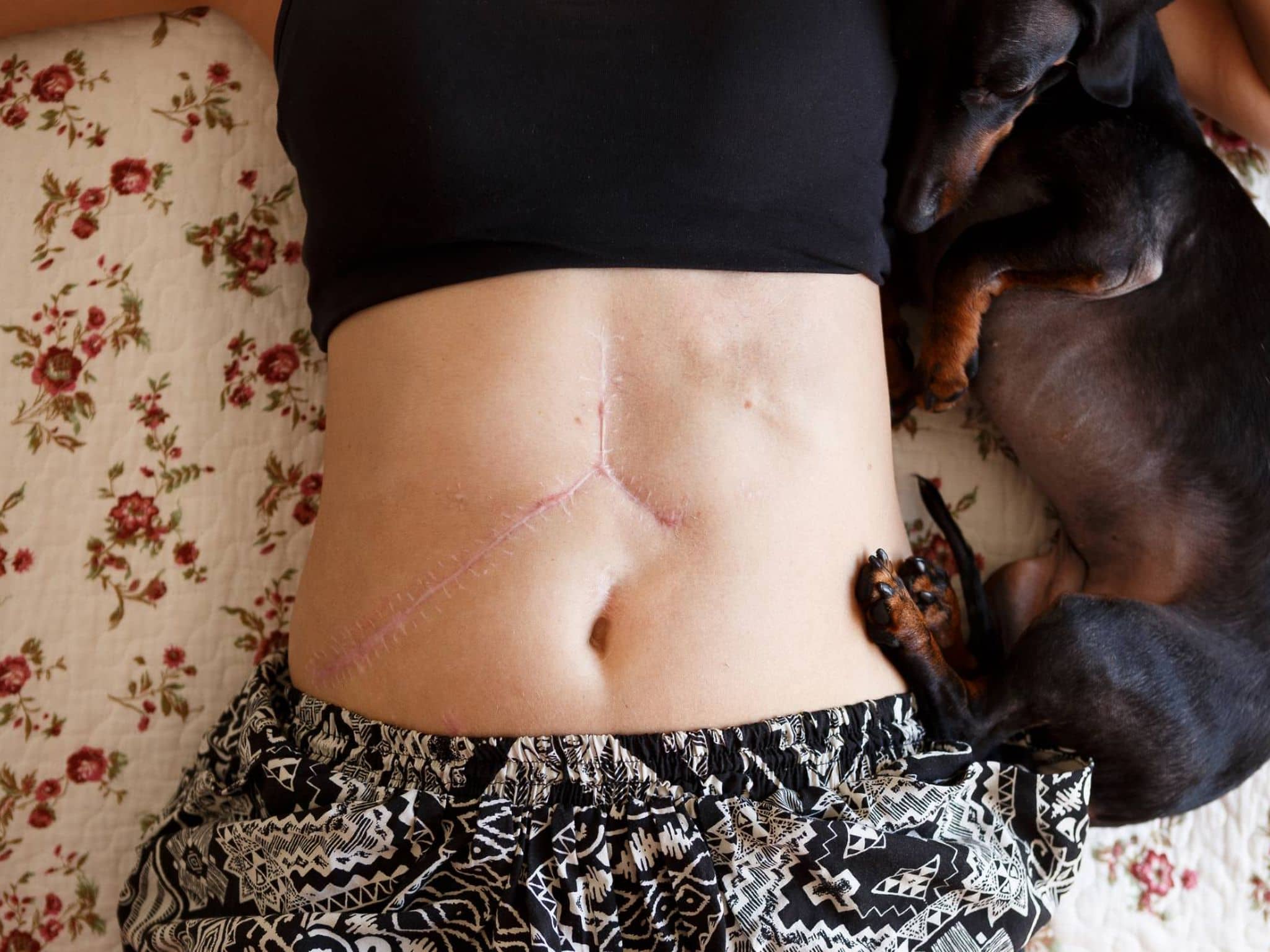 Organspende: Bauch einer Frau mit Operationsnarbe