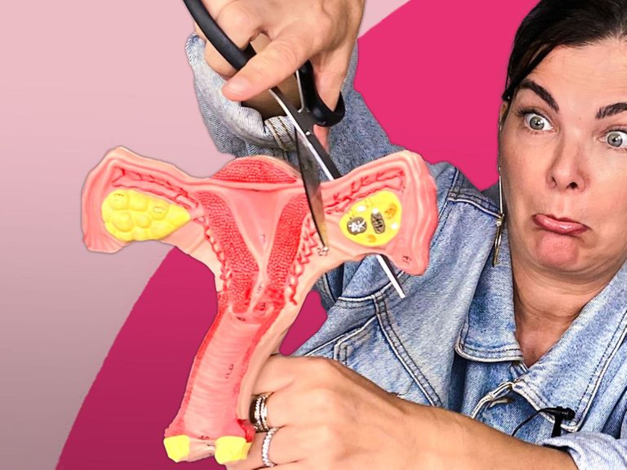 Symbolbild Sterilisation der Frau